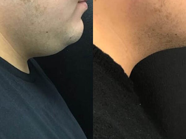 Double-Chin-Reduction-2