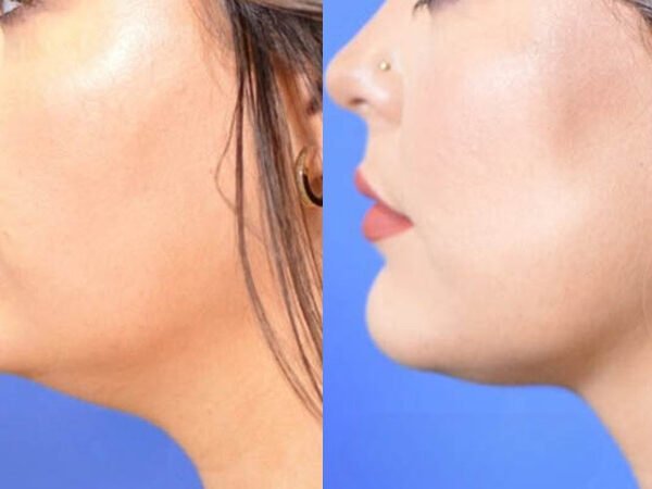 Double-Chin-Reduction-3