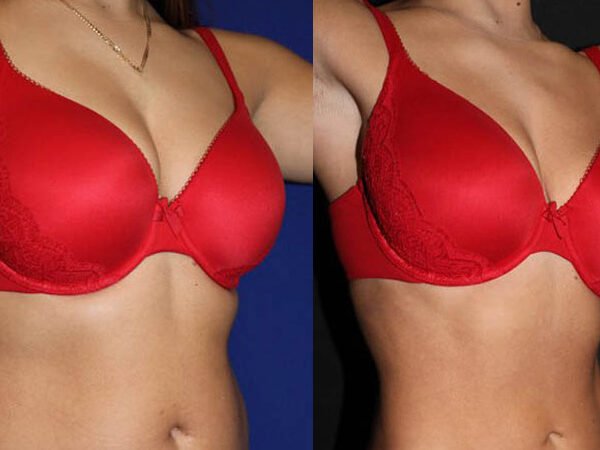 EMSCULPT-Before-After-3