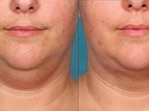 Lemon-Bottle-Before-After-3