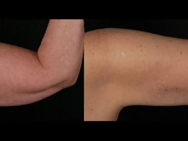 Fat-freezing-near-me-before-after-2