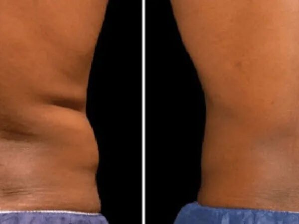 Fat-freezing-near-me-before-after-3