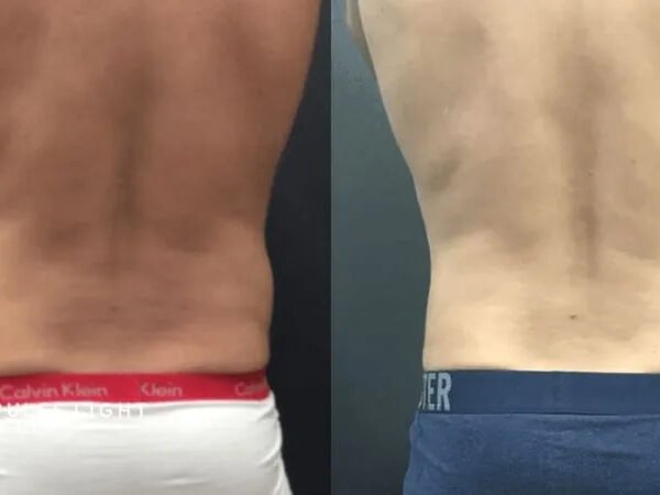 Fat-freezing-near-me-before-after-4