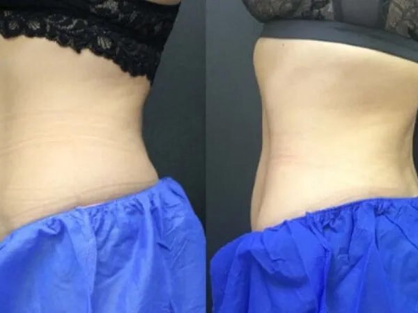 Fat-freezing-near-me-before-after-6