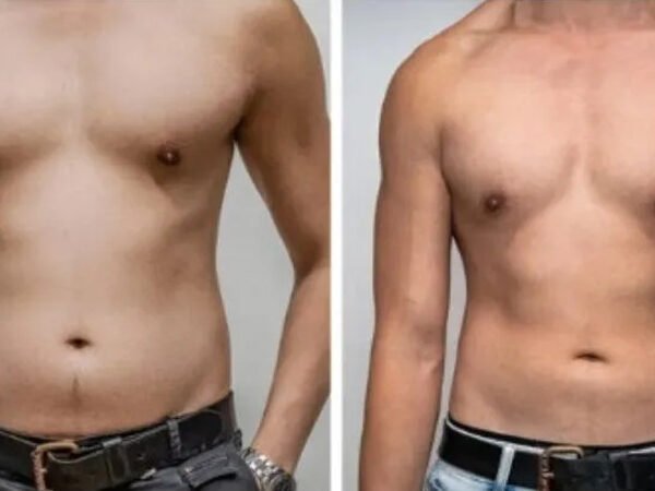Fat-freezing-near-me-before-after-7