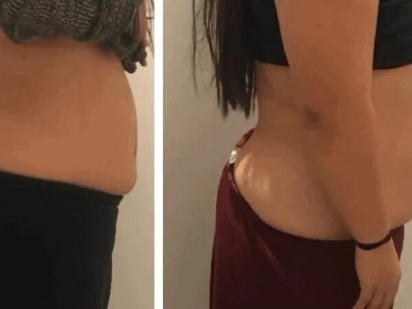 Fat-freezing-near-me-before-after-8
