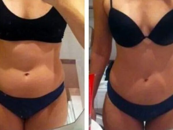 Fat-freezing-near-me-before-after-9